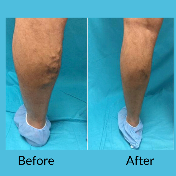 Vein Treatment Before & After - North Hollywood, FL - Minars Dermatology