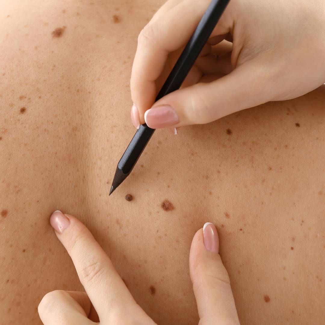 minars dermatology skin cancer detection screening and treatment dermatologist hollywood fl dermatology clinic