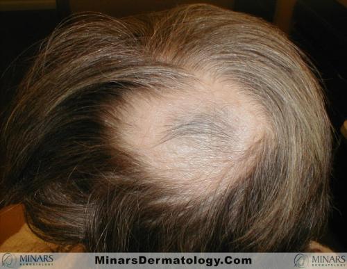 Alopecia Areata A