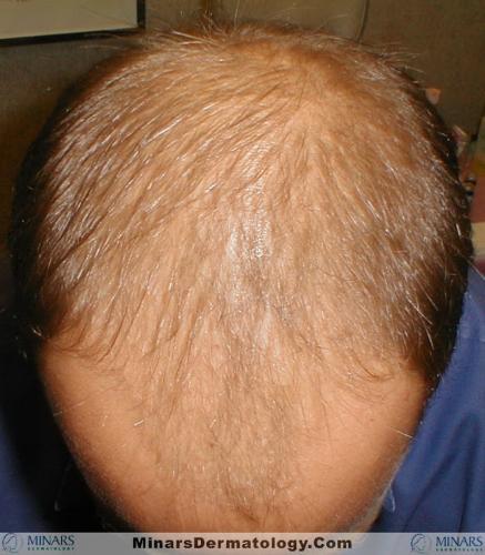 Androgenetic Alopecia 1 A