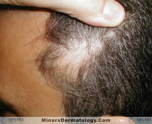Congenital Triangular Alopecia 2 A