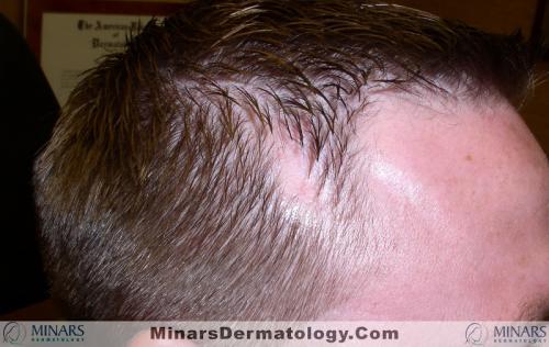 Congenital Triangular Alopecia A
