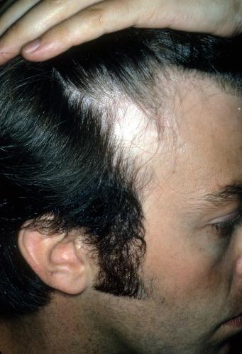 congenital triangular alopecia